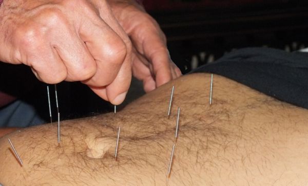 Picture of acupuncture being done to a patient. 